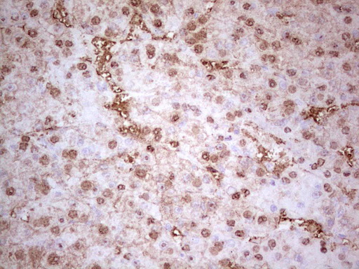 MTOR Antibody - Immunohistochemical staining of paraffin-embedded Carcinoma of Human liver tissue using anti-MTOR mouse monoclonal antibody. (Heat-induced epitope retrieval by 1 mM EDTA in 10mM Tris, pH8.5, 120C for 3min,