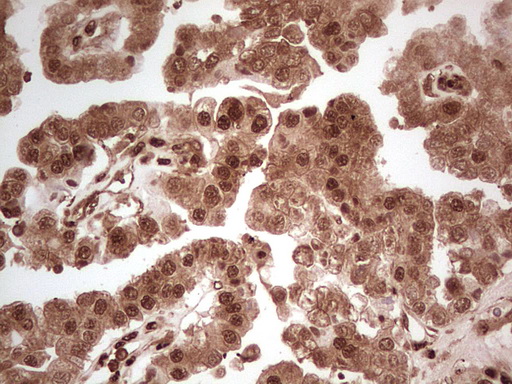 MTOR Antibody - IHC of paraffin-embedded Adenocarcinoma of Human ovary tissue using anti-MTOR mouse monoclonal antibody. (Heat-induced epitope retrieval by 1 mM EDTA in 10mM Tris, pH8.5, 120°C for 3min).