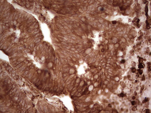 MTOR Antibody - IHC of paraffin-embedded Adenocarcinoma of Human colon tissue using anti-MTOR mouse monoclonal antibody. (Heat-induced epitope retrieval by 1 mM EDTA in 10mM Tris, pH8.5, 120°C for 3min).