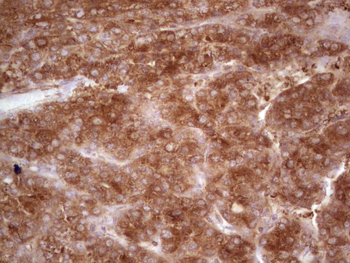 MTOR Antibody - IHC of paraffin-embedded Carcinoma of Human liver tissue using anti-MTOR mouse monoclonal antibody. (Heat-induced epitope retrieval by 1 mM EDTA in 10mM Tris, pH8.5, 120°C for 3min).