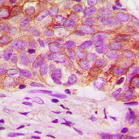 MTOR Antibody - Immunohistochemical analysis of mTOR staining in human prostate cancer formalin fixed paraffin embedded tissue section. The section was pre-treated using heat mediated antigen retrieval with sodium citrate buffer (pH 6.0). The section was then incubated with the antibody at room temperature and detected using an HRP conjugated compact polymer system. DAB was used as the chromogen. The section was then counterstained with hematoxylin and mounted with DPX.