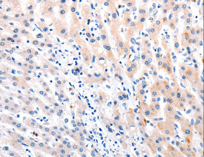 MTOR Antibody - Immunohistochemistry of paraffin-embedded Human liver cancer using MTOR Polyclonal Antibody at dilution of 1:60.