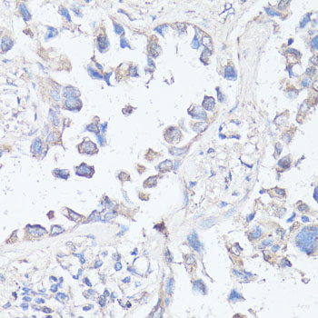MTOR Antibody - Immunohistochemistry of paraffin-embedded human lung cancer using MTOR antibody at dilution of 1:100 (40x lens).
