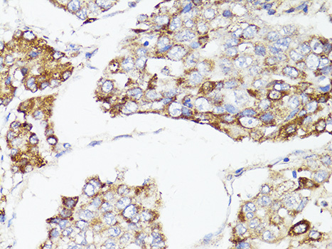 MTOR Antibody - Immunohistochemistry of paraffin-embedded human liver cancer using mTOR antibody at dilution of 1:150 (40x lens).