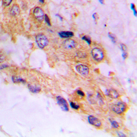 MTOR Antibody - Immunohistochemical analysis of mTOR (pS2448) staining in human prostate cancer formalin fixed paraffin embedded tissue section. The section was pre-treated using heat mediated antigen retrieval with sodium citrate buffer (pH 6.0). The section was then incubated with the antibody at room temperature and detected using an HRP conjugated compact polymer system. DAB was used as the chromogen. The section was then counterstained with hematoxylin and mounted with DPX.