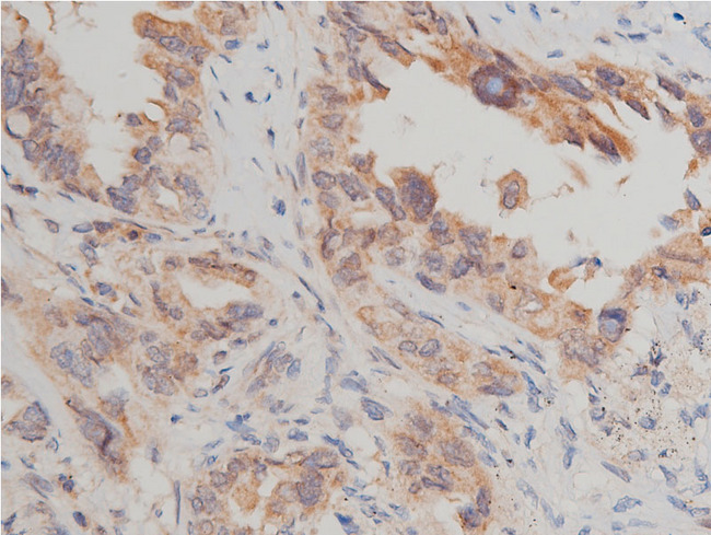 MTOR Antibody - 1:50 staining human lung carcinoma tissue by IHC-P. The tissue was formaldehyde fixed and a heat mediated antigen retrieval step in citrate buffer was performed. The tissue was then blocked and incubated with the antibody for 1.5 hours at 22°C. An HRP conjugated goat anti-rabbit antibody was used as the secondary.
