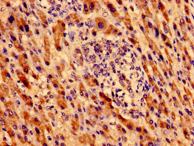 MTRF1 Antibody - Immunohistochemistry of paraffin-embedded human liver cancer using MTRF1 Antibody at dilution of 1:100