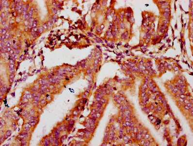 MTSS1 / MIM Antibody - Immunohistochemistry Dilution at 1:400 and staining in paraffin-embedded human endometrial cancer performed on a Leica BondTM system. After dewaxing and hydration, antigen retrieval was mediated by high pressure in a citrate buffer (pH 6.0). Section was blocked with 10% normal Goat serum 30min at RT. Then primary antibody (1% BSA) was incubated at 4°C overnight. The primary is detected by a biotinylated Secondary antibody and visualized using an HRP conjugated SP system.