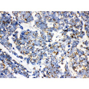MtTFA / TFAM Antibody - mtTFA antibody IHC-paraffin. IHC(P): Human Lung Cancer Tissue.