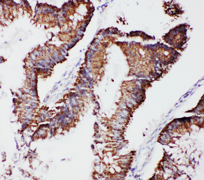 MtTFA / TFAM Antibody - MtTFA / TFAM antibody. IHC(P): Human Intestinal Cancer Tissue.