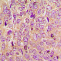 MtTFA / TFAM Antibody - Immunohistochemical analysis of TCF6 staining in human breast cancer formalin fixed paraffin embedded tissue section. The section was pre-treated using heat mediated antigen retrieval with sodium citrate buffer (pH 6.0). The section was then incubated with the antibody at room temperature and detected using an HRP conjugated compact polymer system. DAB was used as the chromogen. The section was then counterstained with hematoxylin and mounted with DPX.