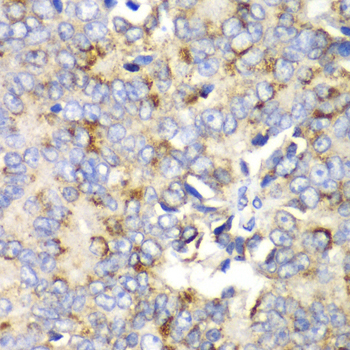 MtTFA / TFAM Antibody - Immunohistochemistry of paraffin-embedded human prostate cancer tissue.