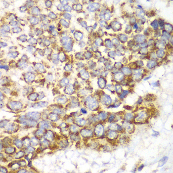 MtTFA / TFAM Antibody - Immunohistochemistry of paraffin-embedded human esophageal cancer tissue.