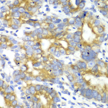 MtTFA / TFAM Antibody - Immunohistochemistry of paraffin-embedded human gastric cancer tissue.