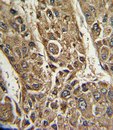 MTTP / MTP Antibody - Formalin-fixed and paraffin-embedded human hepatocarcinoma with MTTP Antibody , which was peroxidase-conjugated to the secondary antibody, followed by DAB staining. This data demonstrates the use of this antibody for immunohistochemistry; clinical relevance has not been evaluated.