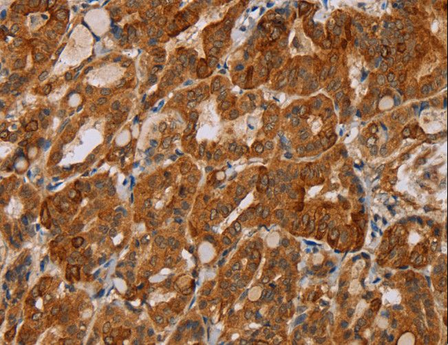 MTUS1 Antibody - Immunohistochemistry of paraffin-embedded Human breast cancer using MTUS1 Polyclonal Antibody at dilution of 1:40.