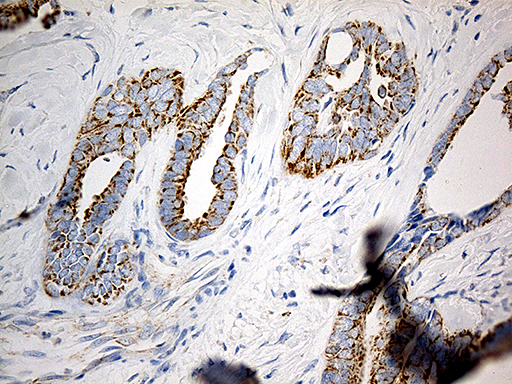 MTX2 Antibody - Immunohistochemical staining of paraffin-embedded Adenocarcinoma of Human ovary tissue using anti-MTX2 mouse monoclonal antibody. (Heat-induced epitope retrieval by 1mM EDTA in 10mM Tris buffer. (pH8.5) at 120°C for 3 min. (1:500)