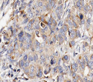 MUC13 Antibody - 1:100 staining human ovarian carcinoma tissue by IHC-P. The tissue was formaldehyde fixed and a heat mediated antigen retrieval step in citrate buffer was performed. The tissue was then blocked and incubated with the antibody for 1.5 hours at 22°C. An HRP conjugated goat anti-rabbit antibody was used as the secondary.