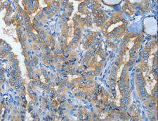 MUC15 Antibody - Immunohistochemistry of paraffin-embedded Human lung cancer using MUC15 Polyclonal Antibody at dilution of 1:50.