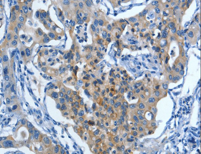 MUC15 Antibody - Immunohistochemistry of paraffin-embedded Human lung cancer using MUC15 Polyclonal Antibody at dilution of 1:50.