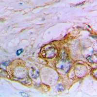 MUC16 / CA125 Antibody - Immunohistochemical analysis of MUC16 staining in human bladder cancer formalin fixed paraffin embedded tissue section. The section was pre-treated using heat mediated antigen retrieval with sodium citrate buffer (pH 6.0). The section was then incubated with the antibody at room temperature and detected using an HRP conjugated compact polymer system. DAB was used as the chromogen. The section was then counterstained with hematoxylin and mounted with DPX.