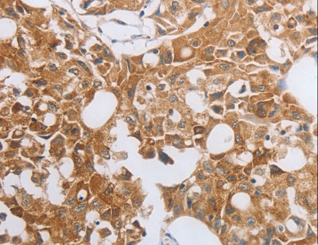 MUC20 Antibody - Immunohistochemistry of paraffin-embedded Human lung cancer using MUC20 Polyclonal Antibody at dilution of 1:40.
