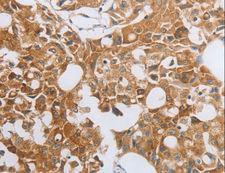 MUC20 Antibody - Immunohistochemistry of paraffin-embedded Human lung cancer using MUC20 Polyclonal Antibody at dilution of 1:40.
