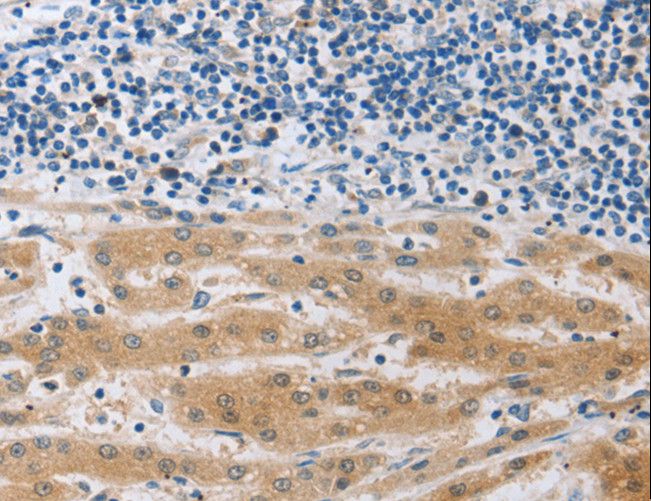 MUC20 Antibody - Immunohistochemistry of paraffin-embedded Human liver cancer using MUC20 Polyclonal Antibody at dilution of 1:40.