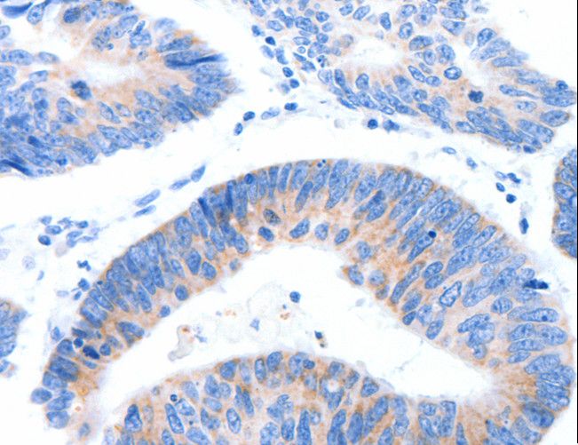 MUC3A Antibody - Immunohistochemistry of paraffin-embedded Human lung cancer using MUC3A Polyclonal Antibody at dilution of 1:60.