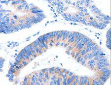 MUC3A Antibody - Immunohistochemistry of paraffin-embedded Human lung cancer using MUC3A Polyclonal Antibody at dilution of 1:60.