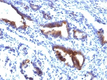 MUC3A Antibody - Formalin-fixed, paraffin-embedded human gastric carcinoma stained with Mucin-3 antibody (M3.1).  This image was taken for the unmodified form of this product. Other forms have not been tested.
