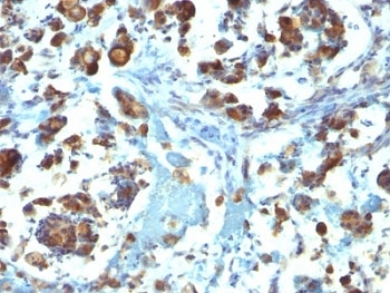 MUC3A Antibody - Formalin-fixed, paraffin-embedded human gastric carcinoma stained with Mucin-3 antibody (M3.1).  This image was taken for the unmodified form of this product. Other forms have not been tested.