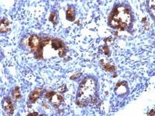 MUC3A Antibody - Formalin-fixed, paraffin-embedded human gastric carcinoma stained with MUC3 antibody (MUC3/1154).  This image was taken for the unmodified form of this product. Other forms have not been tested.