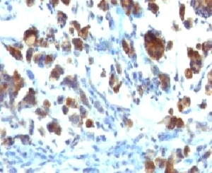 MUC3A Antibody - Formalin-fixed, paraffin-embedded human gastric carcinoma stained with MUC3 antibody (MUC3/1154).  This image was taken for the unmodified form of this product. Other forms have not been tested.