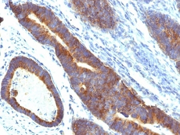 MUC3A Antibody - Formalin-fixed, paraffin-embedded human colon carcinoma stained with MUC3 antibody (MUC3/1154).  This image was taken for the unmodified form of this product. Other forms have not been tested.