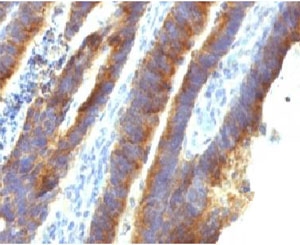 MUC3A Antibody - IHC testing of FFPE human colon carcinoma with MUC3 antibody (clone MUCN3-1).  This image was taken for the unmodified form of this product. Other forms have not been tested.