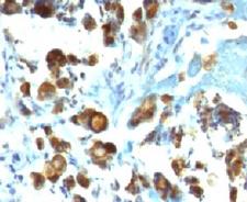 MUC3A Antibody - IHC testing of FFPE human gastric carcinoma with MUC3 antibody (clone MUCN3-1).  This image was taken for the unmodified form of this product. Other forms have not been tested.