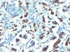 MUC3A Antibody - Formalin-fixed, paraffin-embedded human gastric carcinoma stained with anti-MUC3 antibody (SPM200).  This image was taken for the unmodified form of this product. Other forms have not been tested.