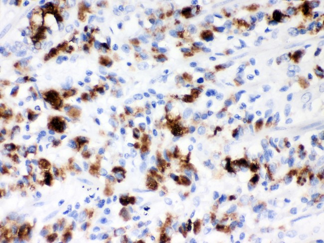 MUC5AC Antibody - Mucin-5AC antibody IHC-paraffin: Human Gastric Cancer Tissue.