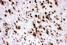 MUC5AC Antibody - IHC analysis of Mucin 5AC using anti-Mucin 5AC antibody. Mucin 5AC was detected in paraffin-embedded section of human gastric cancer tissue. Heat mediated antigen retrieval was performed in citrate buffer (pH6, epitope retrieval solution) for 20 mins. The tissue section was blocked with 10% goat serum. The tissue section was then incubated with 1µg/ml rabbit anti-Mucin 5AC Antibody overnight at 4°C. Biotinylated goat anti-rabbit IgG was used as secondary antibody and incubated for 30 minutes at 37°C. The tissue section was developed using Strepavidin-Biotin-Complex (SABC) with DAB as the chromogen.