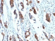 MUC5AC Antibody - Formalin-fixed, paraffin-embedded human gastric carcinoma stained with MUC5AC antibody (58M1).  This image was taken for the unmodified form of this product. Other forms have not been tested.