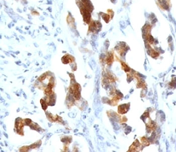 MUC5AC Antibody - Formalin-fixed, paraffin-embedded human gastric carcinoma stained with MUC5AC antibody (CLH2).  This image was taken for the unmodified form of this product. Other forms have not been tested.