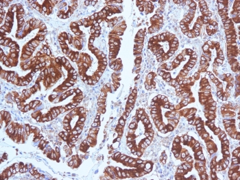 MUC5AC Antibody - IHC testing of FFPE human gastric carcinoma with MUC5AC antibody (clone CLH2). Required HIER: steam section in pH6 citrate buffer for 20 min and allow to cool prior to testing.