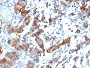 MUC5AC Antibody - Formalin-fixed, paraffin-embedded human gastric carcinoma stained with MUC5AC antibody (MUC5AC/917 + 45M1).  This image was taken for the unmodified form of this product. Other forms have not been tested.
