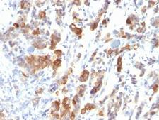 MUC5AC Antibody - Formalin-fixed, paraffin-embedded human gastric carcinoma stained with MUC5 antibody (MUC5AC/917).  This image was taken for the unmodified form of this product. Other forms have not been tested.