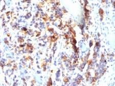 MUC5AC Antibody - Formalin-fixed, paraffin-embedded human gastric carcinoma stained with Mucin-5AC antibody (SPM297).  This image was taken for the unmodified form of this product. Other forms have not been tested.