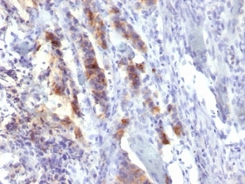 MUC5AC Antibody - Formalin-fixed, paraffin-embedded human gastric carcinoma stained with MUC5-AC antibody (SPM488).  This image was taken for the unmodified form of this product. Other forms have not been tested.