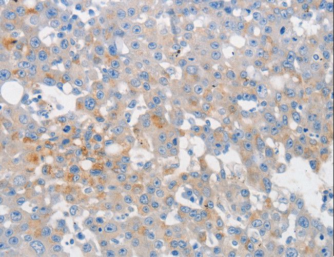 MUC5AC Antibody - Immunohistochemistry of paraffin-embedded Human breast cancer using MUC5AC Polyclonal Antibody at dilution of 1:80.