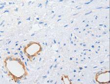 MUC5AC Antibody - Immunohistochemistry of paraffin-embedded Human cervical cancer using MUC5AC Polyclonal Antibody at dilution of 1:100.