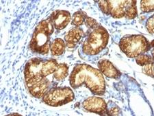 MUC6 / MUC-6 Antibody - Formalin-fixed, paraffin-embedded human gastric carcinoma stained with MUC6 antibody (CLH5).  This image was taken for the unmodified form of this product. Other forms have not been tested.